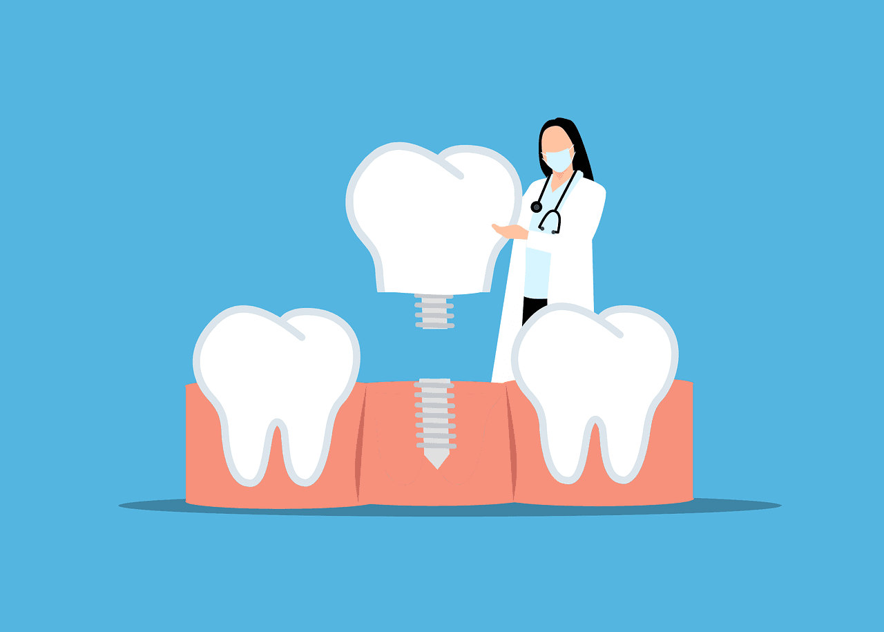 dental implant