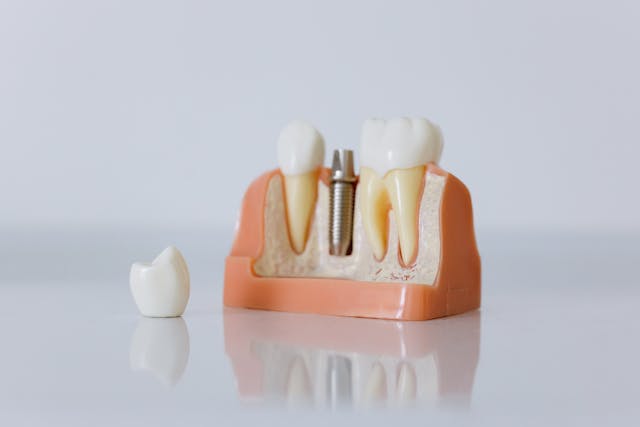 dental crowns