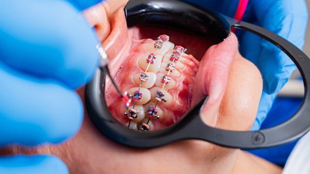 invisalign