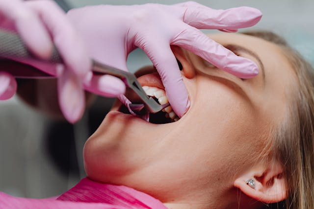 tooth extraction