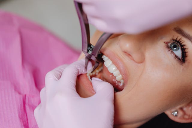 tooth removal
