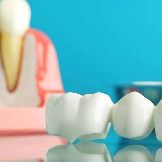 dental crowns