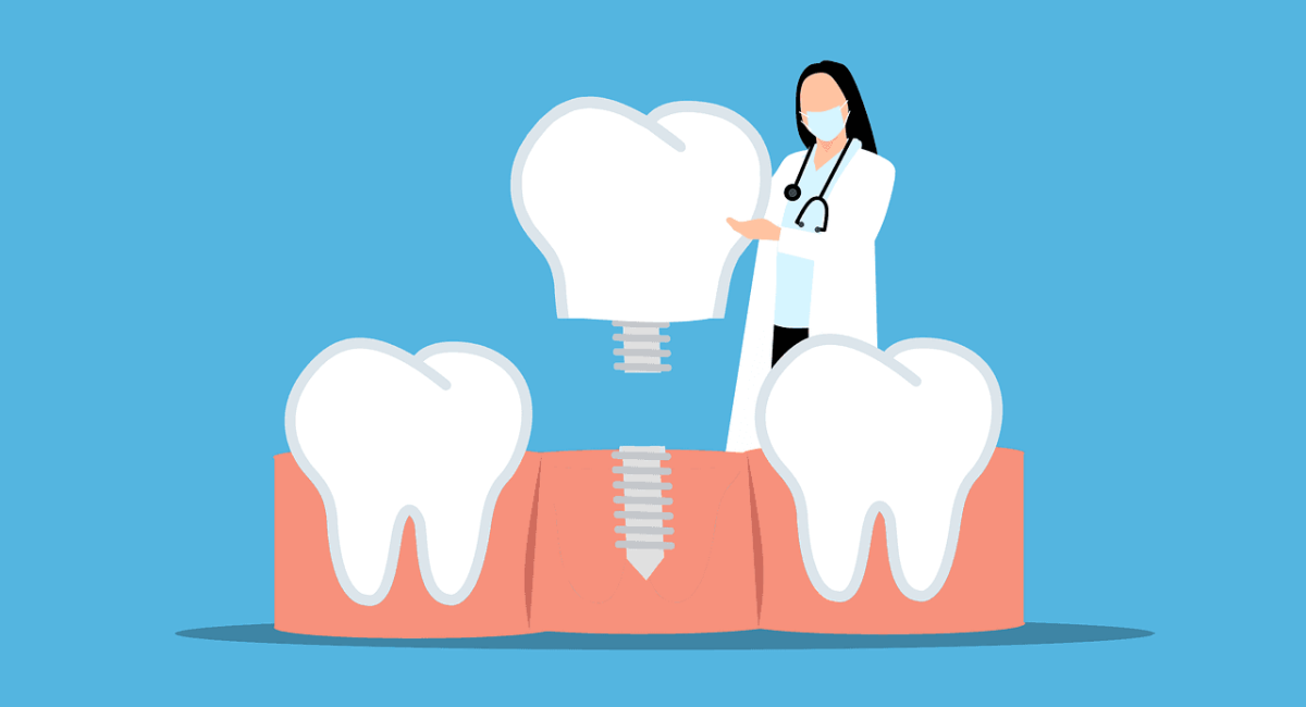 dental implant