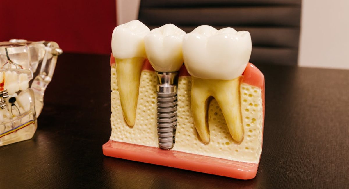 dental implants