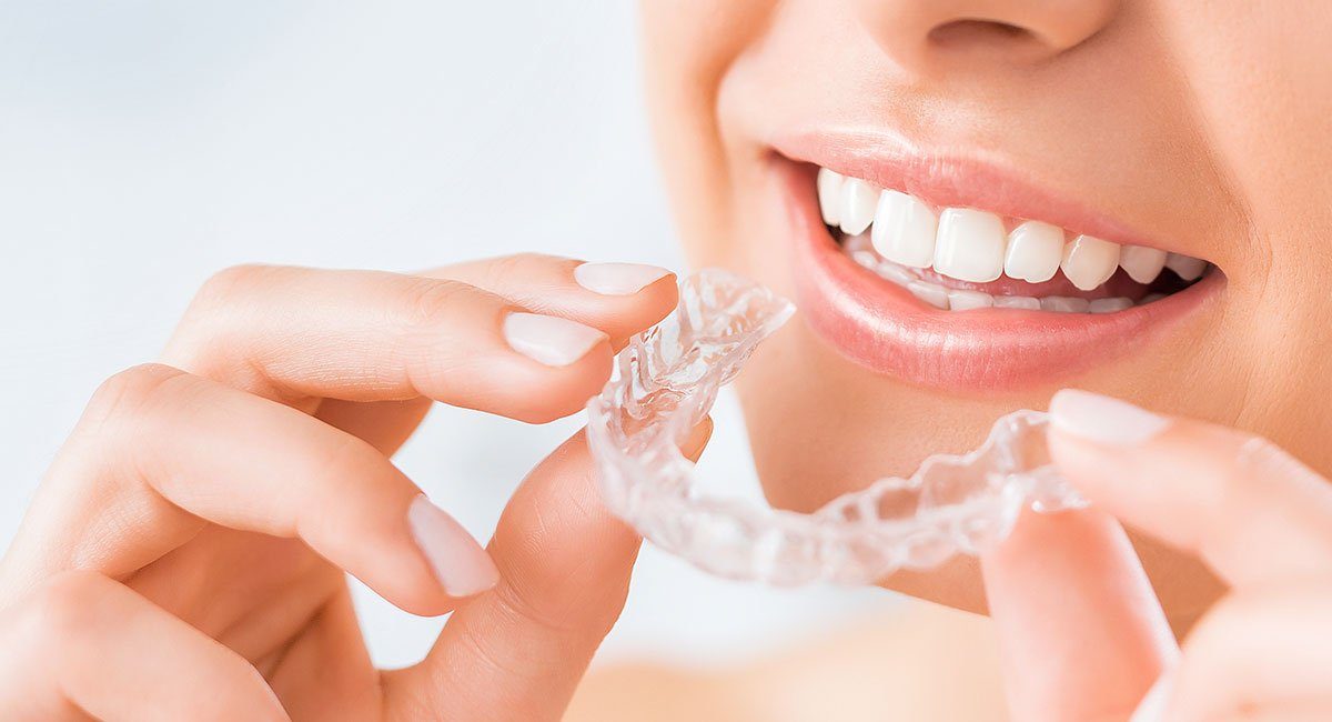 straighten-teeth-clear-aligners1